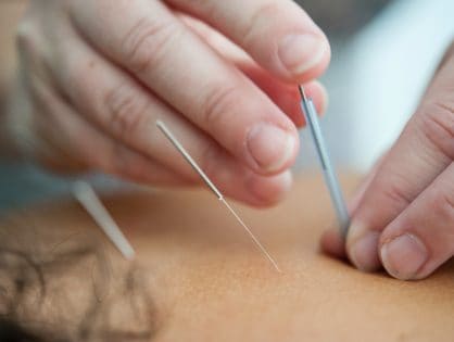 Why sign up for acupuncture?